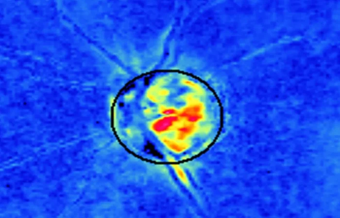 Zerstörung der Nervenfasern durch Augeninnendruckerhöhung