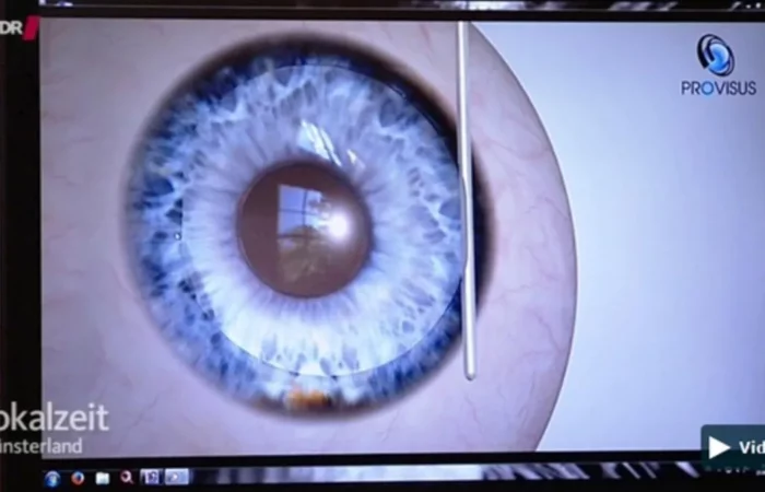 Die Lokalzeit Münsterland des WDR begleitet einen jungen Mann zu seiner Lasik-OP in die Augenklinik Ahaus.