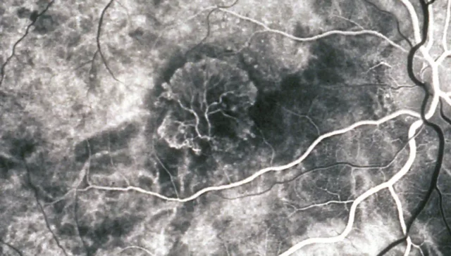 Darstellung der undichten Blutgefäße mit einem Fluoreszenz-Kontrastmittel