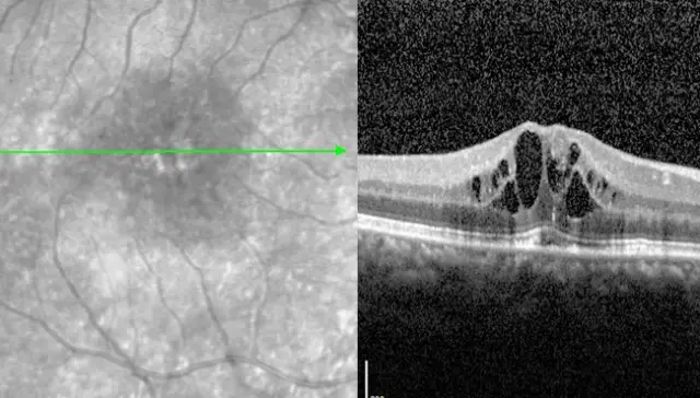 Diabetisch macula-oedeem