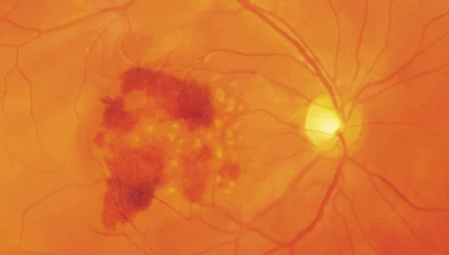 Blutungen im Bereich der Makula bei feuchter AMD