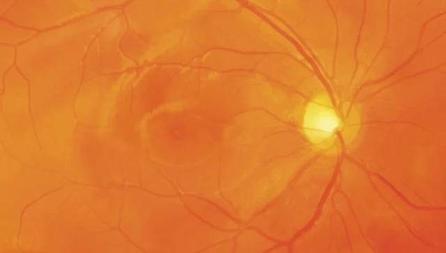 Gesunde Makula - Altersabhängige Makuladegeneration - Augenärzte Gerl & Kollegen