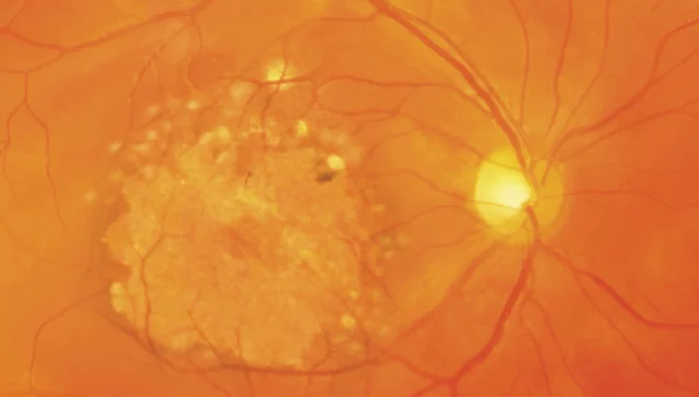 Sehr ausgeprägtes Spätstadium der trockenen AMD