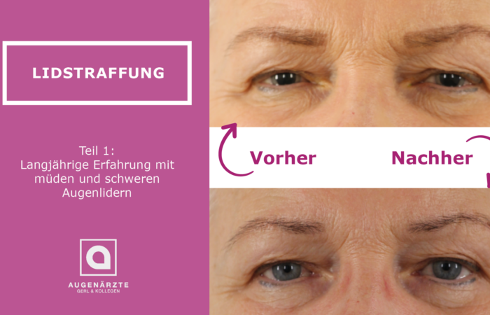 Lidstraffung Teil1 - Lidstraffung in der Augenklinik Ahaus - Augenärzte Gerl & Kollegen