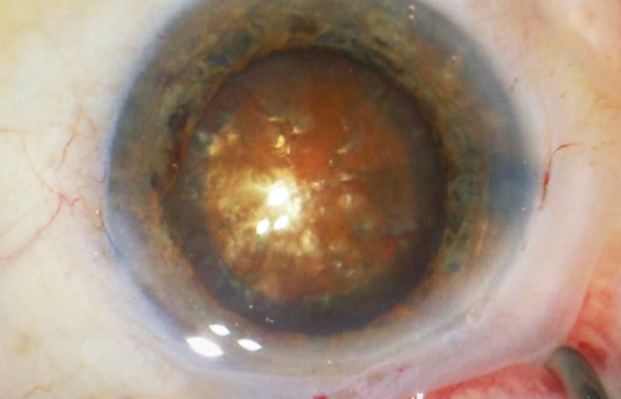 Cataracta nigra Dr.Gerl - Uganda Eye-Camp 3.0 | Häufige Diagnose: Schwarzer Star - Augenärzte Gerl & Kollegen