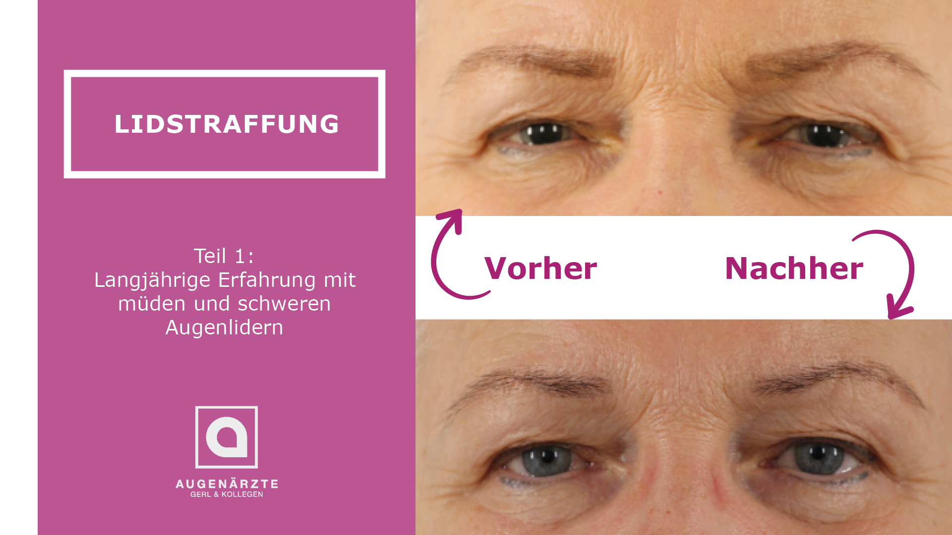 Lidstraffung | Teil 1