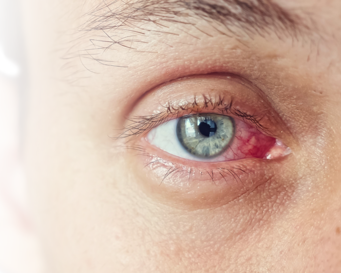 trockene Augen zugeschnitten e1770733739112 - Trockene Augen - Symptome, Ursachen & Behandlung - Augenärzte Gerl & Kollegen